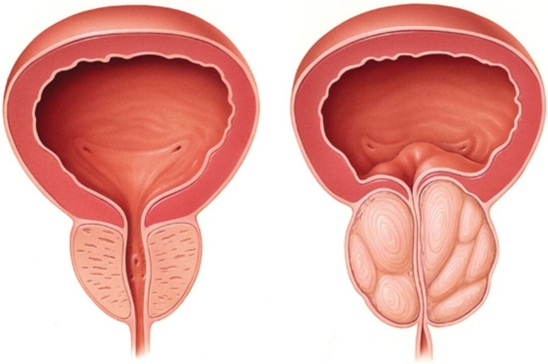 Normāla prostata (pa kreisi) un ar iekaisuma pazīmēm prostatīta gadījumā (pa labi)