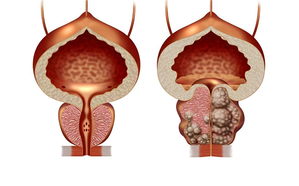 Kā izskatās prostatas adenoma 