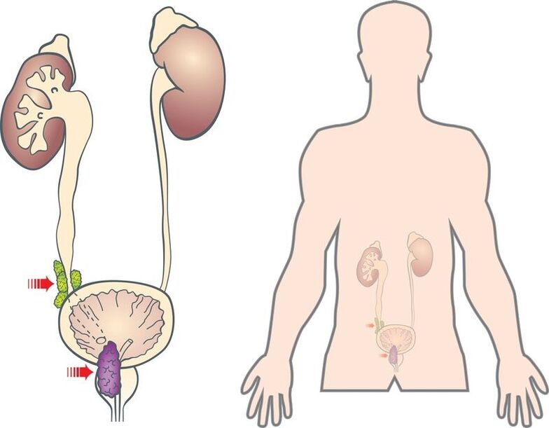 Prostatas adenomas simptomi un cēloņi