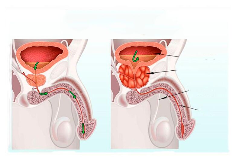 prostatas dziedzera norma un iekaisums