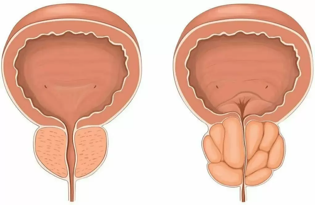 Normāla prostata un sāpīga prostata
