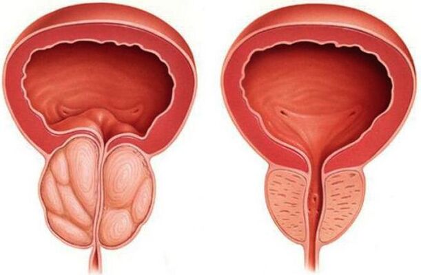 vesela un iekaisusi prostata ar prostatītu